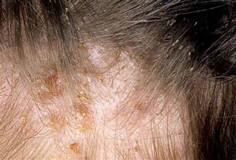 Some Lice Symptoms You Need to Be Aware Of - Health Life and Recipes