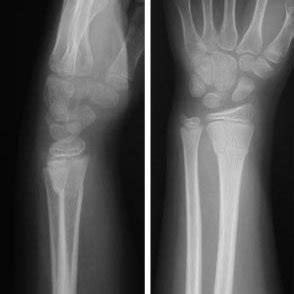 Lateral A And Posteroanterior B Radiographs Of The Wrist Showing A