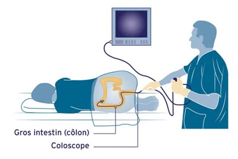 Déroulement Dune Coloscopie Santé Mentale