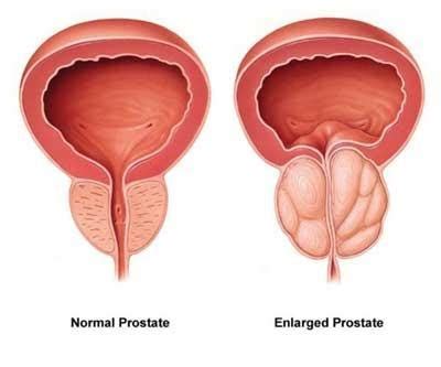 Prostate Artery Embolization Men S Health Procedures Vascular Ohio