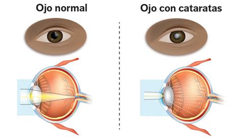 Venta Tipos De Lentes Intraoculares Para Cataratas En Stock