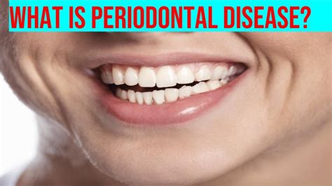 Understanding Periodontal Disease How Can You Prevent It What Are