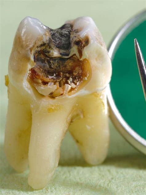 7 Major Signs to Detect Internal Tooth Resorption