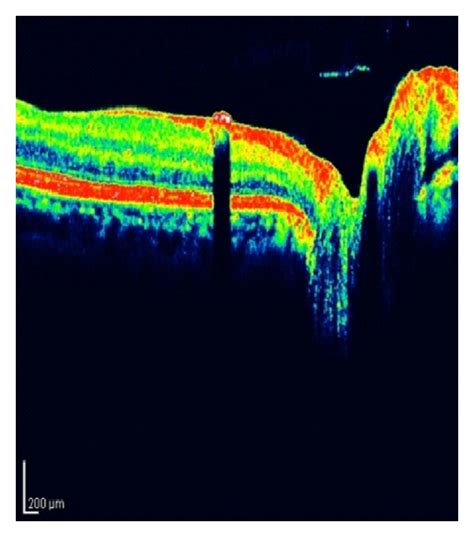 Optical coherence tomography scanning showed an elevated retina at the ...