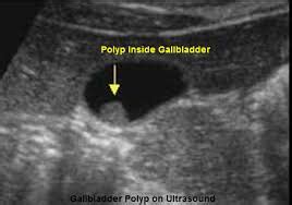 Effective Gallbladder Polyp Treatment in Bangalore Best Doctor,