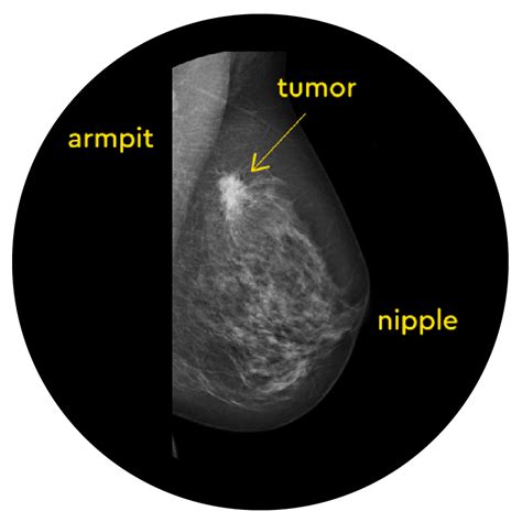 What Is A Mammogram And When To Get A Mammogram — Know Your Lemons® For