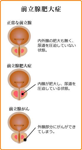 前立腺肥大症とは 医新会