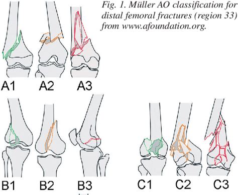 Figure 1 From Current Concepts In Fractures Of The Distal Femur Semantic Scholar