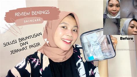 REVIEW JUJUR PEMAKAIAN ACNE SKINCARE BENING BY DR OKY PRATAMA