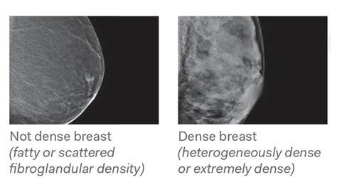 Breast Density 1 Diagnostic Imaging NW