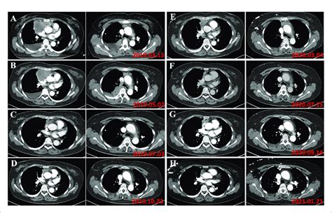 A In March The Patient Was Diagnosed As Type B Thymoma With