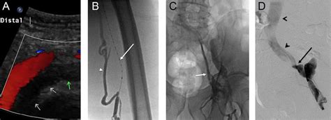 A) Left lower extremity venous duplex ultrasound demonstrating ...