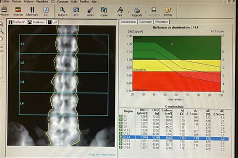 Ostéodensitométrie Imev Radiologie Lyon Villeurbanne