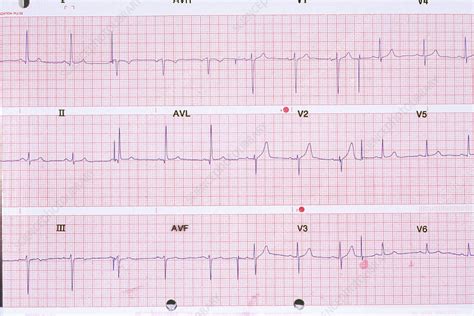 Healthy Ekg Stock Image C0048272 Science Photo Library