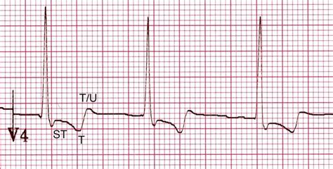 Digoxin Effect • Litfl • Ecg Library Toxicology