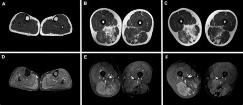 Muscle MRI. Muscle MRI at calf level (patient 3) showing incipient ...