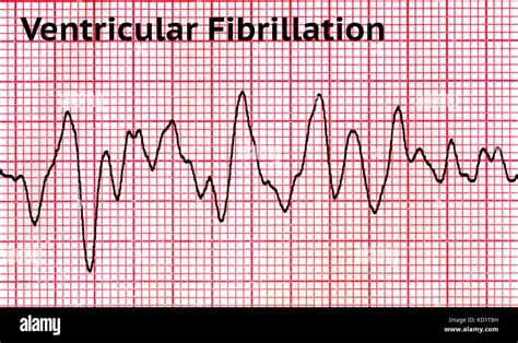 Ventricular Fibrillation Images – Browse 4,365 Stock, 56% OFF