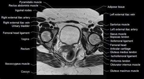 Pelvis Muscles Mri Anatomy Mri Female Pelvis Anatomy Axial Image | Sexiz Pix