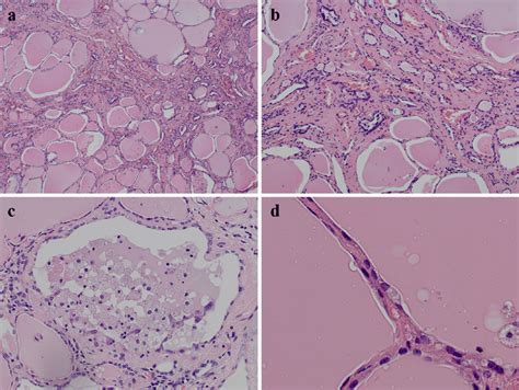 Figure2.The pathological findings of the thyroid. Atrophic follicles ...