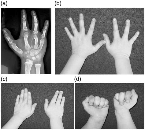 Insights Into The Pathogenesis And Treatment Of Splithand Foot