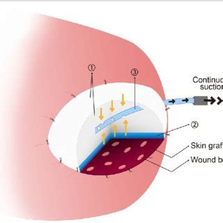 (PDF) Modified bolster dressing with continuous suction improves skin ...