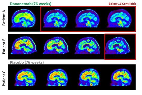 New Drug Donanemab Shows Promise: Advancements in Early Alzheimer's ...