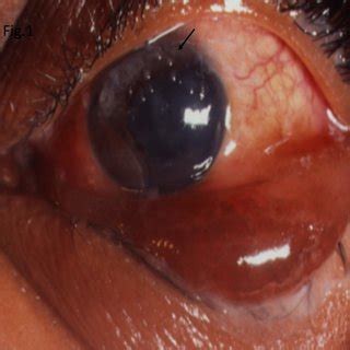 Slit Lamp Photograph Of The Left Eye Showing Periorbital Edema