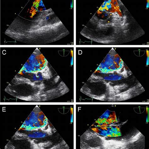 Transoesophageal Echocardiography Colour Doppler Imaging Demonstrates