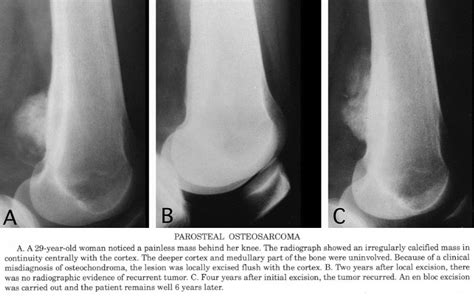 Pathology Outlines Parosteal Osteosarcoma