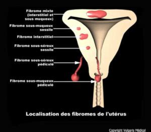 Fibromes Ut Rins Localisation Anatomie Photo Et Illustration