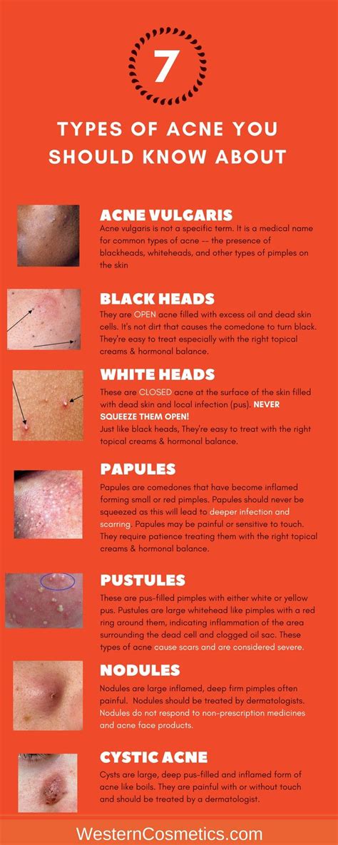 7 Types Of Acne You Need To Be Aware Of And How They Are Treated Types Of Acne Natural Skin