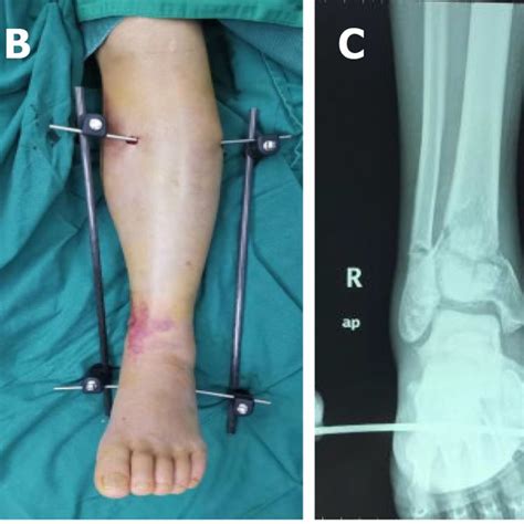 Illustrative Case 3 A Radiograph After Injury Aoota 43 C3 B Soft