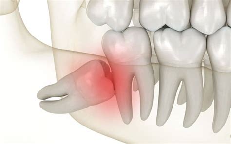 How Can A Dentist Remove A Partially Erupted Wisdom Tooth Tooth Truths