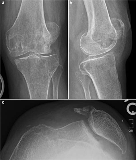 Figure 1 From Combined Total Knee Arthroplasty And Medial