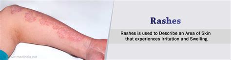 Rashes - Frequently Asked Questions / FAQs