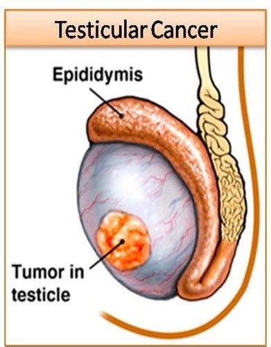 Prostate Cancer Flashcards Quizlet