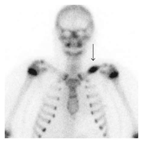 A Tc M Mdp Bone Scan Ap Image Shows Intense Focus Of Radioisotope