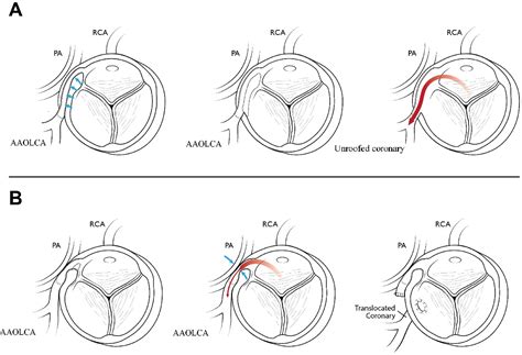 Anomalous Aortic Origin Of The Coronary Arteries State Of The Art