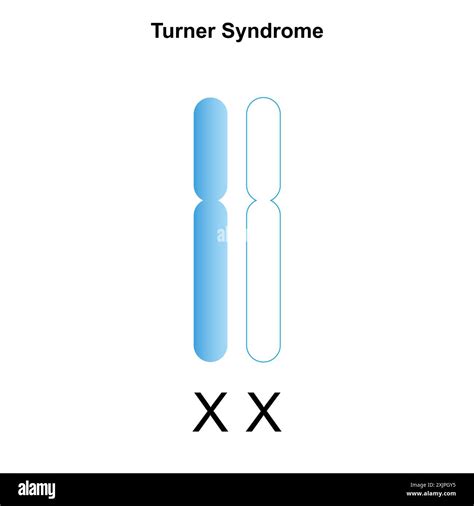 Turner syndrome hi-res stock photography and images - Alamy 