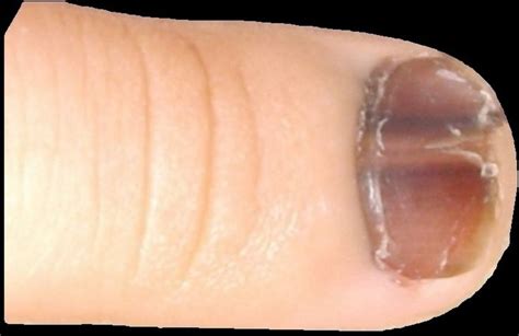 Melanoma Under Nail Bed Photos Bios Pics