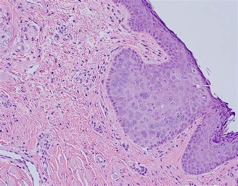 Sebaceous Carcinoma Histology