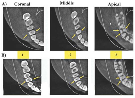 Axial Cbct Image For Local And Non Local Maxillary First Premolar At