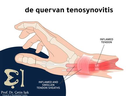 Hand tendonitis; Its problems and ways to solve them - Dr. What's wrong with you?