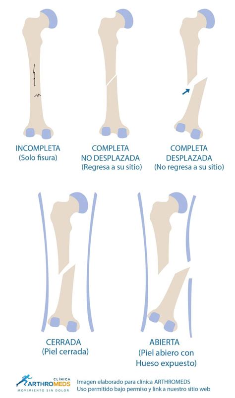 Como Curar Una Fractura De Hueso Lima Perú