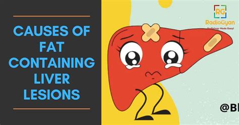 Fat Containing Liver Lesions Visual Mnemonics Radiogyan