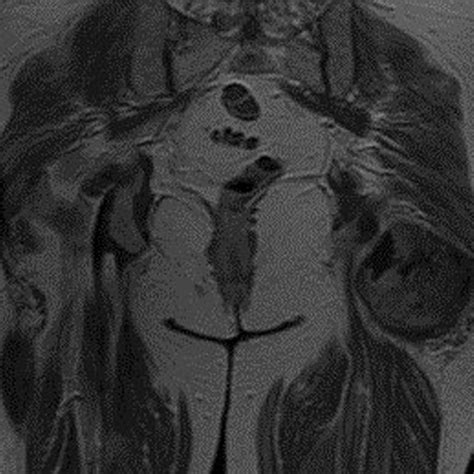 Intramuscular myxoid cyst. | Download Scientific Diagram