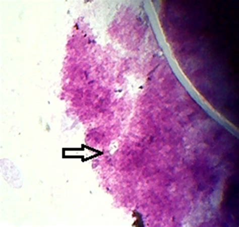 Figure 1b P Carinii Cyst Thropic Form 100x Magnification Successful Empirical Treatment