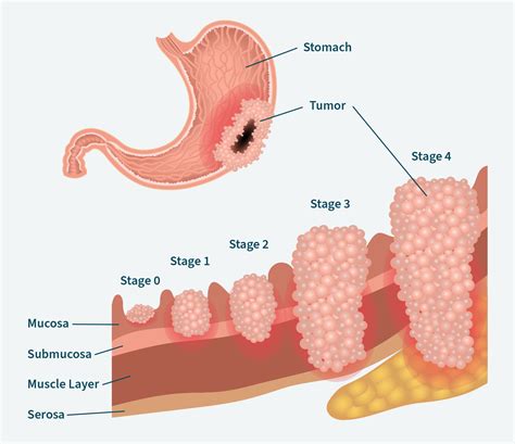 Stages of Stomach (Gastric) Cancer | OurCancerStories