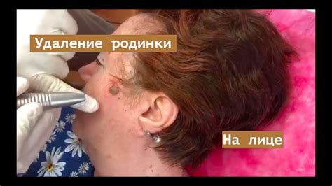 Удаление родинки на лице - YouTube