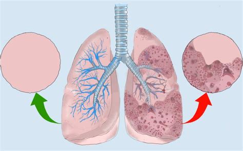 Lungenfibrose Symptome Ursachen Behandlung Prognose